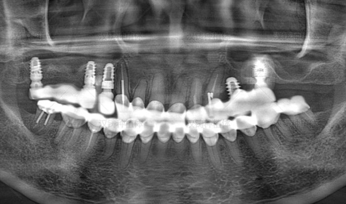 右上第二前磨牙、第二磨牙内提升种植