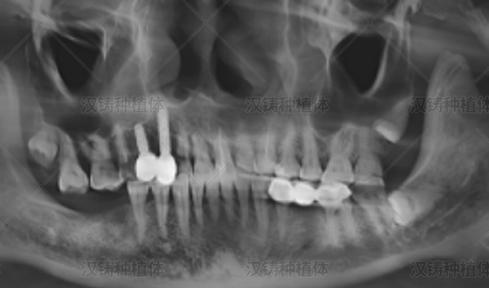 右上尖牙、第一前磨牙上合窦内提升、颊侧GBR两颗