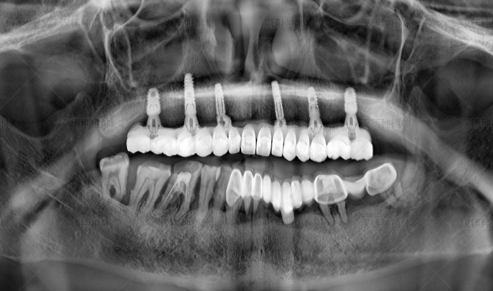 Case Report: Maxillary Full‑Arch Implant Restoration