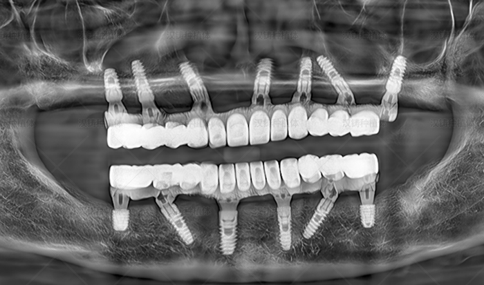 Case Report: Full-Arch Immediate Implant Placement and Restoration