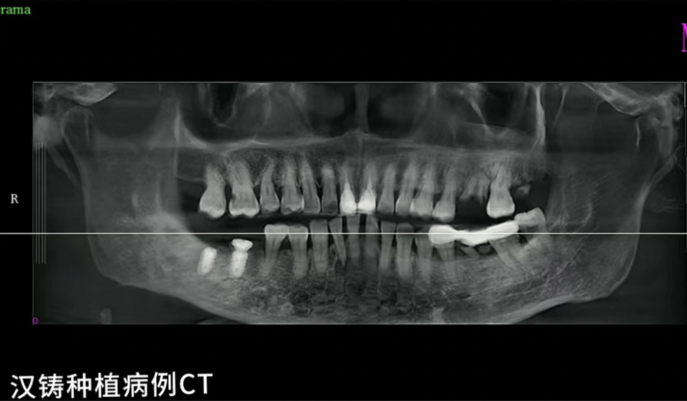 Hanzu Implant Case Presentation