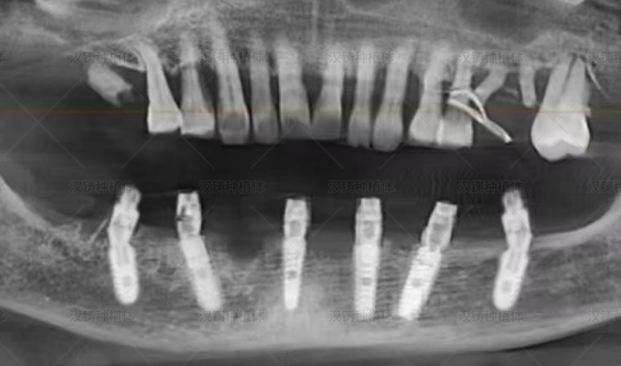 Case Report: Mandibular Full‑Arch Implant Placement with Immediate Loading