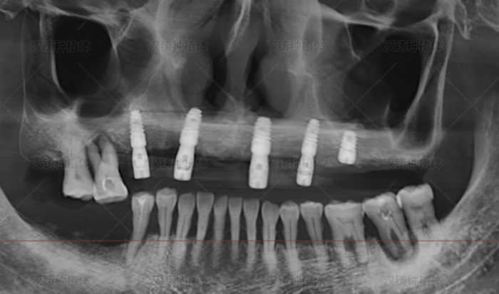 Case Report: Internal Sinus Lift with Immediate Extraction and Implant Placement for Maxilla