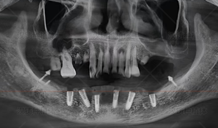 Case Report: Mandibular Full‑Arch Implant Restoration