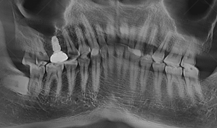 Case Report: Internal Sinus Floor Elevation and Implant Restoration for the Right Maxillary Posterior Tooth