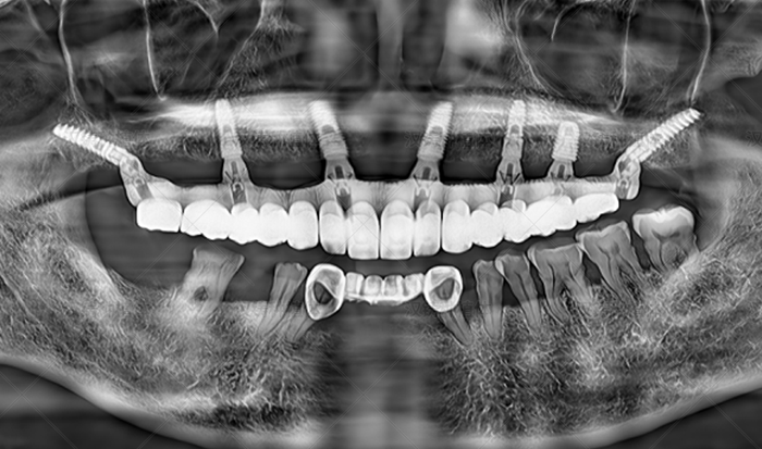 Case Report: Maxillary Full‑Arch Pterygoid Implant Restoration