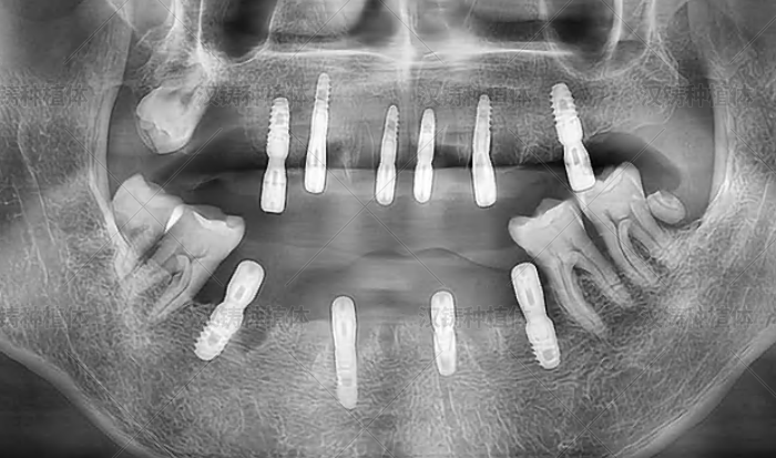 Case Report: Full‑Arch Implant Placement with Immediate Loading