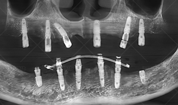 Case Report: Full-Arch Immediate Implant Placement and Immediate Loading