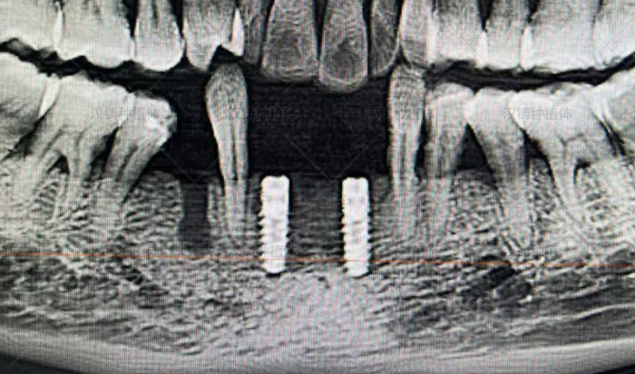 Case Report: GBR Implant Restoration for Mandibular Anterior Teeth
