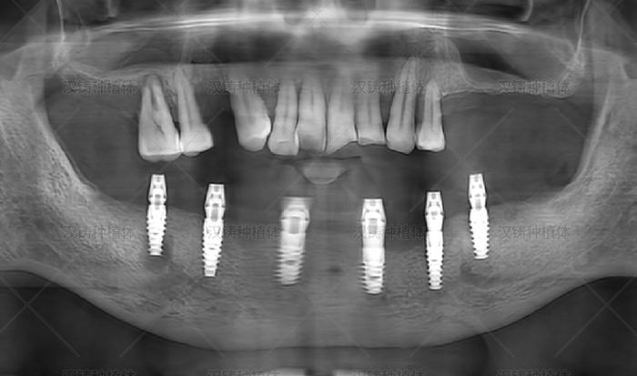 Case Report: Mandibular Full-Arch Immediate Loading Restoration
