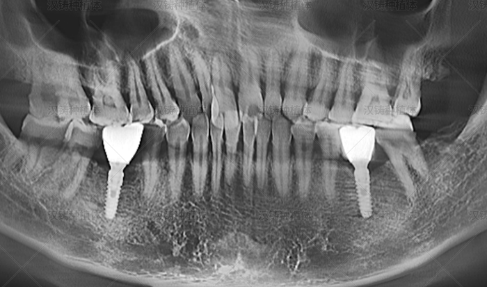 Case Report: Bone Augmentation with Implant Placement for Bilateral Mandibular First Molars