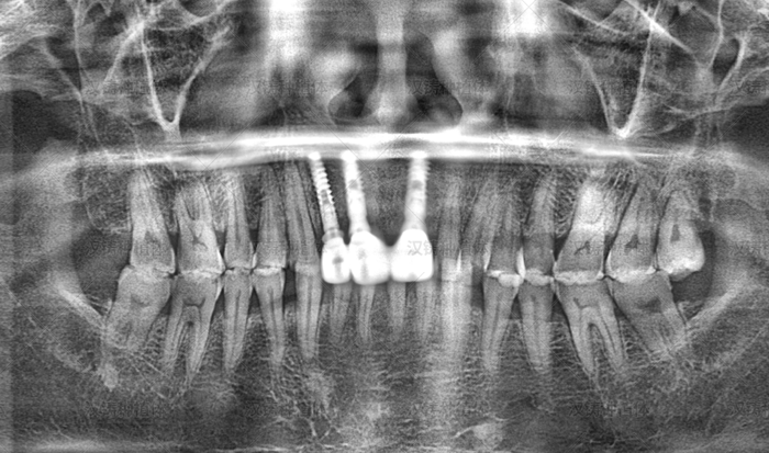 Case Report: Immediate Implant Placement with Labial Autogenous Tooth Bone Graft and Collagen for Maxillary Anterior Teeth